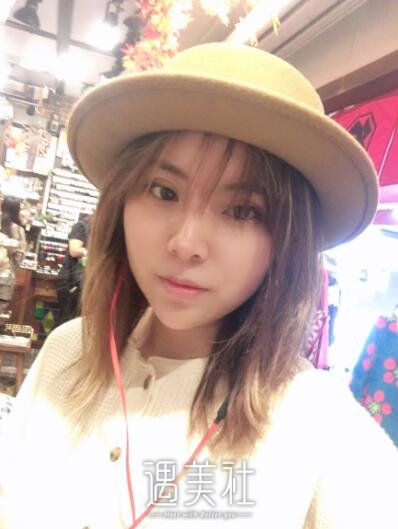 石家庄美联臣整形医院双眼皮案例|原来果果这么好!