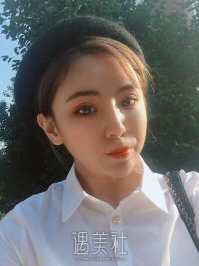 石家庄美联臣整形医院双眼皮案例|原来果果这么好!