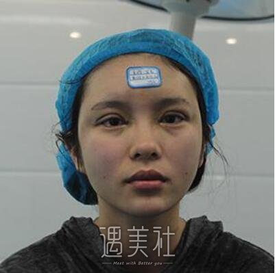 上海九院张余光双眼皮案例|果较为理想!