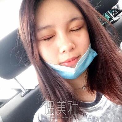 上海九院张余光双眼皮案例|果较为理想!