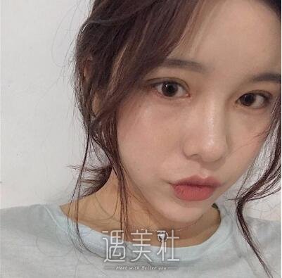 上海九院张余光双眼皮案例|果较为理想!