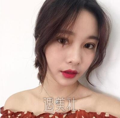 上海九院张余光双眼皮案例|果较为理想!