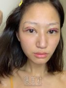 马晓飞医生双眼皮修复案例|拥有双眼皮的感觉真好! width=