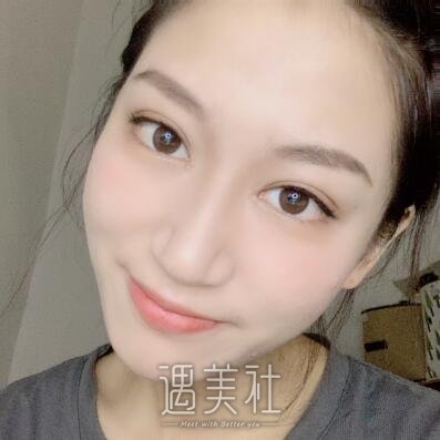 马晓飞医生双眼皮修复案例|拥有双眼皮的感觉真好!