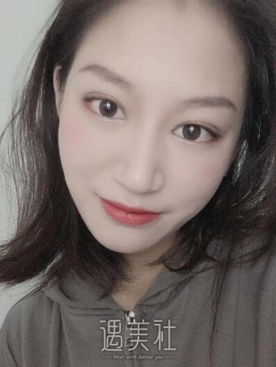 马晓飞医生双眼皮修复案例|拥有双眼皮的感觉真好!