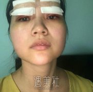 埋线双眼皮案例及对比图分享，前后变化真的很大! width=