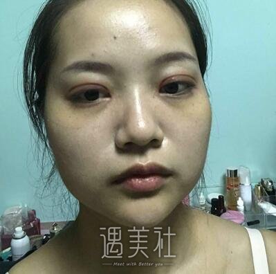 埋线双眼皮案例及对比图分享，前后变化真的很大!