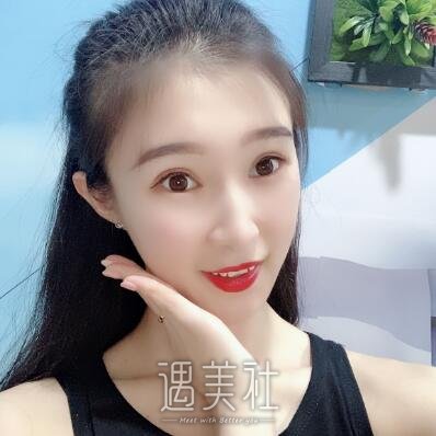 北京润美周明书双眼皮案例|变美就在一线之间!