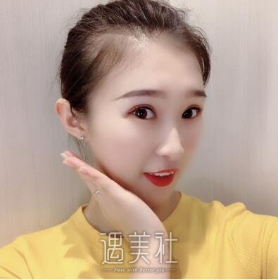 北京润美周明书双眼皮案例|变美就在一线之间!