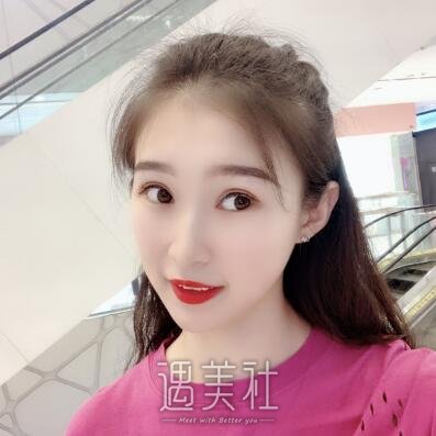 北京润美周明书双眼皮案例|变美就在一线之间!