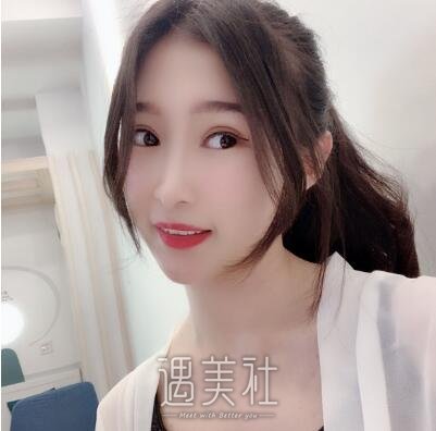北京润美周明书双眼皮案例|变美就在一线之间!