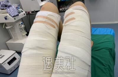 北京润美王明利吸脂案例|致产后的我!