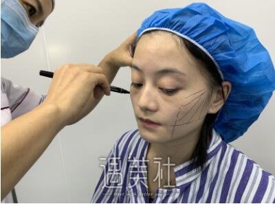 孙玮骏埋线提升案例|变美再也不是梦!