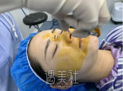 田秋梅隆鼻案例展示，技术确实很不错!