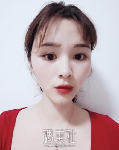 田秋梅隆鼻案例展示，技术确实很不错!