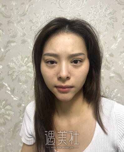 中日友好齐彦文双眼皮案例|妈妈都说果不错!