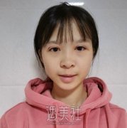 中日友好高占巍双眼皮案例|就此摆脱单眼皮! width=