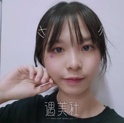 中日友好高占巍双眼皮案例|就此摆脱单眼皮!