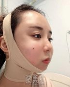 中日友好高占巍磨骨案例|至此拥有秀气脸庞! width=