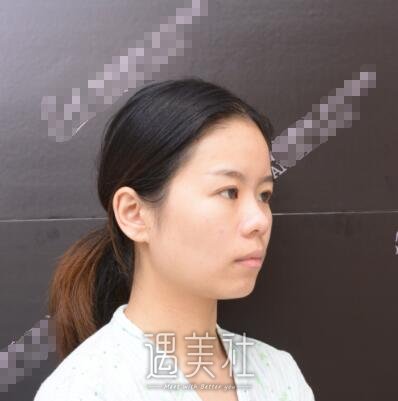 海医悦美常冬青隆鼻案例|果较为满意!