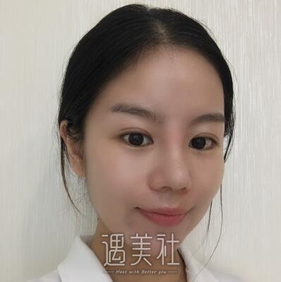 海医悦美常冬青隆鼻案例|果较为满意!