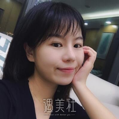 海医悦美常冬青隆鼻案例|果较为满意!