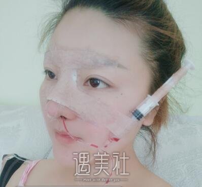 海医悦美林勇隆鼻案例|颜值真的很重要!