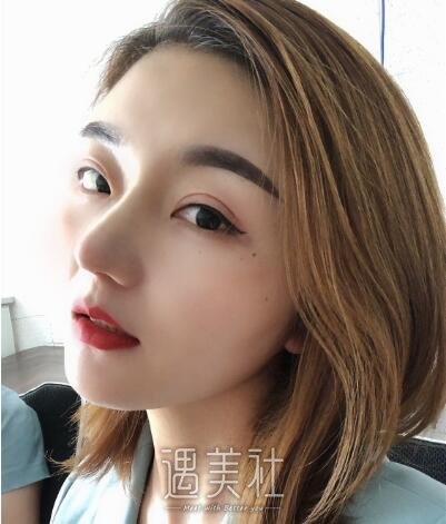 海医悦美林勇隆鼻案例|颜值真的很重要!
