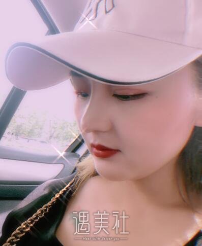 海医悦美林勇隆鼻案例|颜值真的很重要!