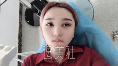 海医悦美林勇双眼皮案例|我也能睁眼看世界了!