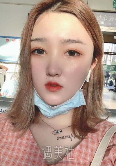 海医悦美林勇双眼皮案例|我也能睁眼看世界了!