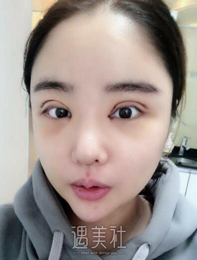 北京美莱杜园园双眼皮案例展示|果真的很不错!