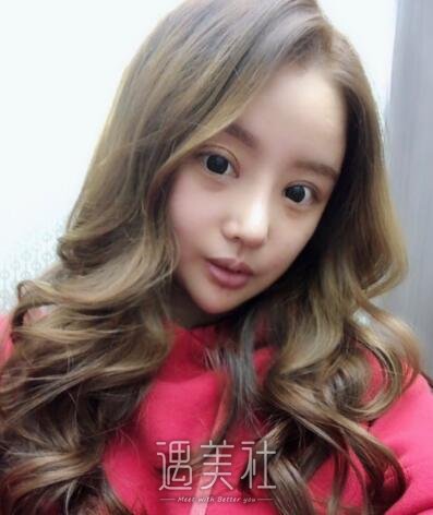北京美莱杜园园双眼皮案例展示|果真的很不错!