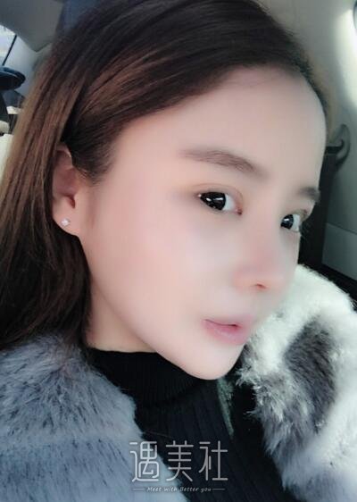 北京美莱杜园园双眼皮案例展示|果真的很不错!