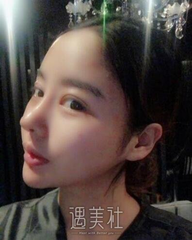 北京美莱杜园园双眼皮案例展示|果真的很不错!