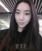 北京美莱曹士华面部脂肪填充案例|肉肉的很可爱! width=