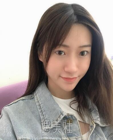 北京美莱欧阳春隆鼻案例|果超出了预期!