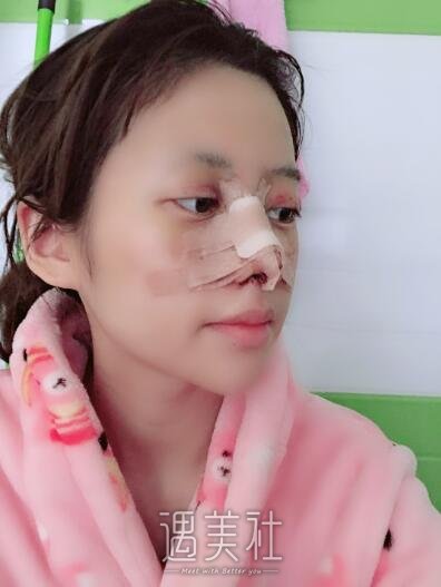 北京美莱欧阳春隆鼻案例|果超出了预期!