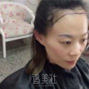深圳碧莲盛植发案例|发量果然变多了! width=