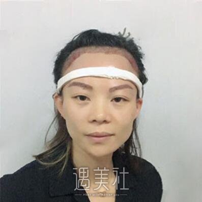 深圳碧莲盛植发案例|发量果然变多了!