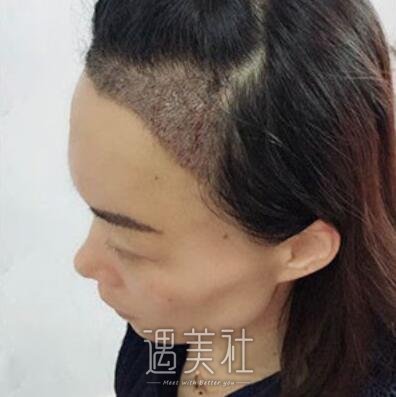 深圳碧莲盛植发案例|发量果然变多了!