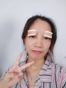 柴云双眼皮修复案例|重新恢复状态! width=