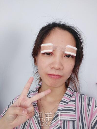 王振军双眼皮修复案例|重新恢复状态!