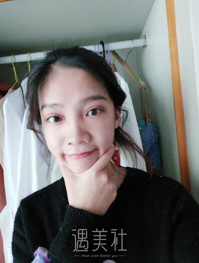 王振军双眼皮修复案例|重新恢复状态!