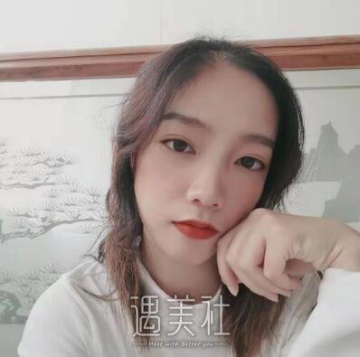 王振军双眼皮修复案例|重新恢复状态!