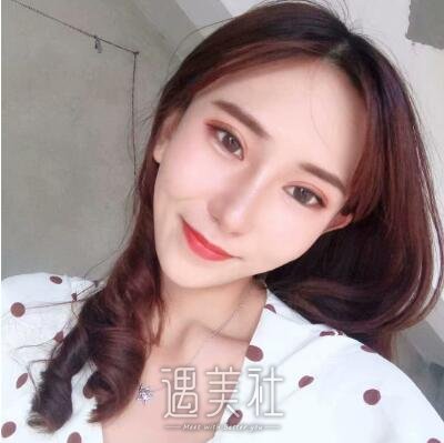 吴炎秋修复双眼皮案例|眼睑不在下垂!
