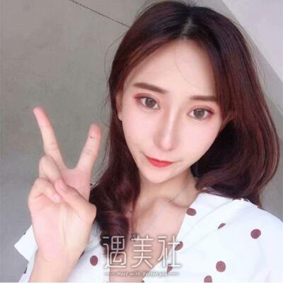 吴炎秋修复双眼皮案例|眼睑不在下垂!.