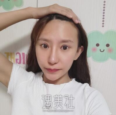 吴炎秋修复双眼皮案例|眼睑不在下垂!