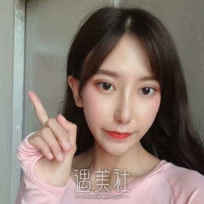 吴炎秋修复双眼皮案例|眼睑不在下垂!