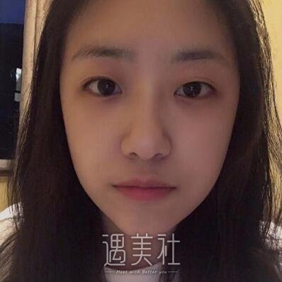 杨小顺双眼皮修复案例|重新恢复自信!